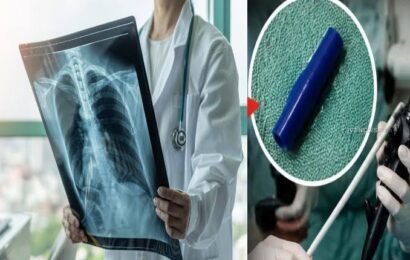 சிறுமியின் நுரையீரலில் 7 ஆண்டுகளாக சிக்கியிருந்த பேனா மூடி; மருத்துவர்கள் ஷாக்!