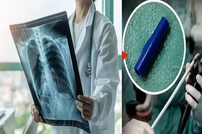 சிறுமியின் நுரையீரலில் 7 ஆண்டுகளாக சிக்கியிருந்த பேனா மூடி; மருத்துவர்கள் ஷாக்!