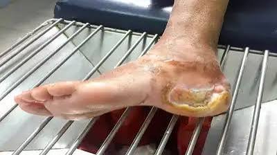 புண் ஆறவே இல்லை அலட்சியம் வேண்டாம் !